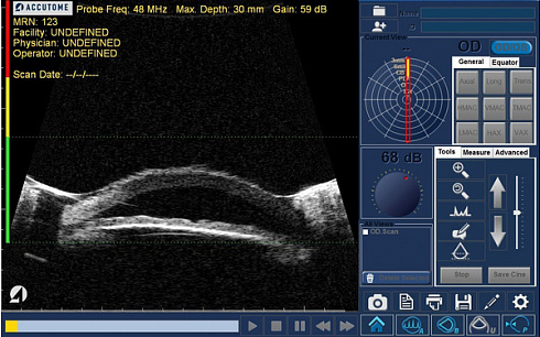 Ультразвуковая офтальмологическая система диагностики 4Sight: A scan, B scan, пахиметрия 